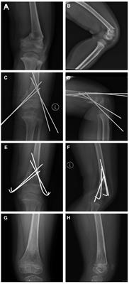 Displaced supracondylar femoral fractures: Clinical and radiographic outcomes in children aged 4–10 years treated with Kirschner wires and hip spica cast